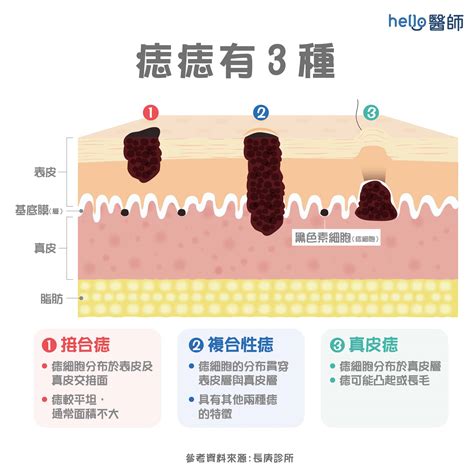 痣長毛原因|痣上长毛是什么原因